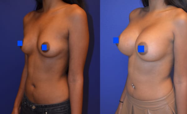 indonesian nude girls sex boob job info