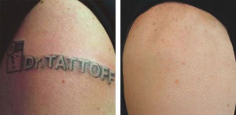 Remove Tatto on Tattoo Removal   Before And After   Yelp